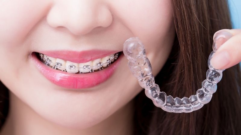 Invisalign and Braces