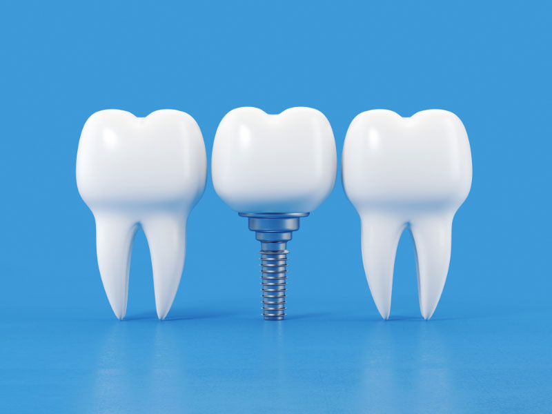 Dental Implants