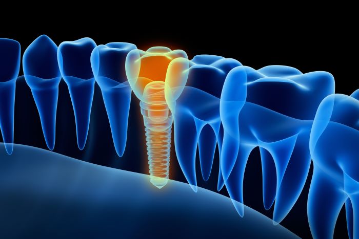 Dental Implant Edgewater