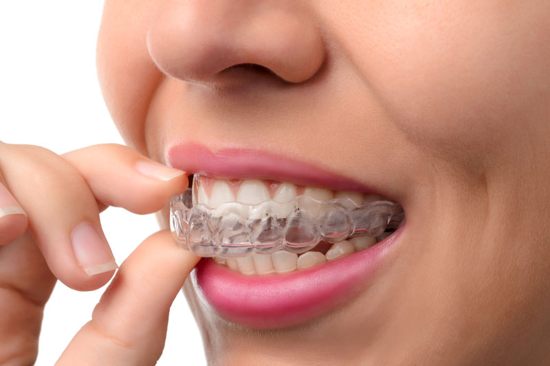 How Can I Keep My Invisalign Attachments and Invisalign Trays Clean?