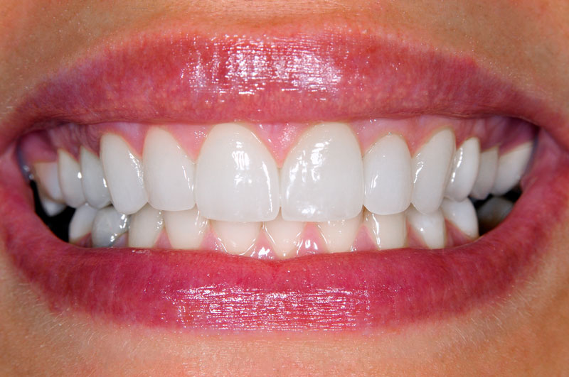 Teeth Whitening