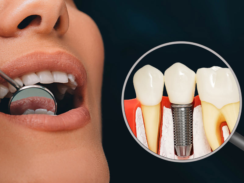 Dental Implants