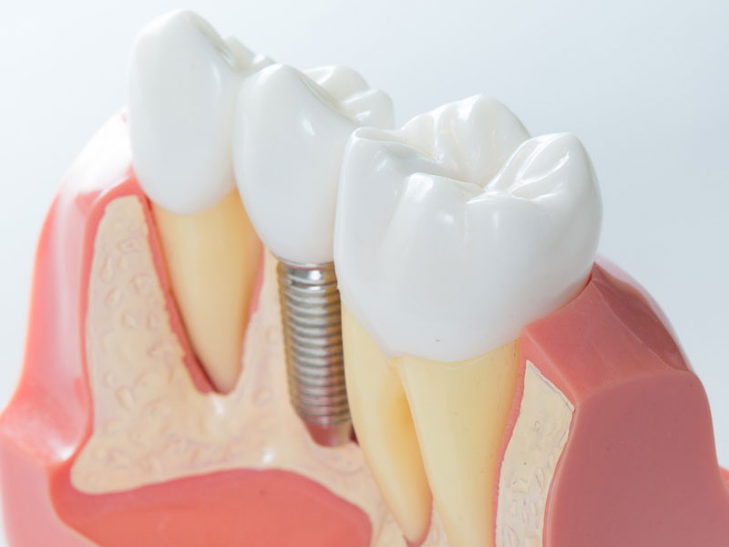 Dental Implants